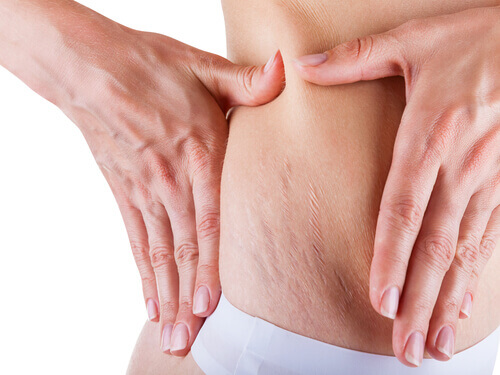 Най-често засегнати от стриите са корема, гърдите и задните части