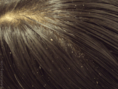 Естествени средства срещу пърхот