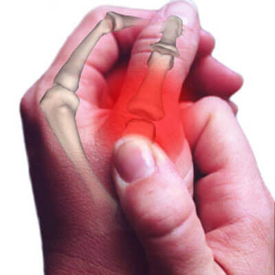 Болката в дланите може да се дължи на артрит.