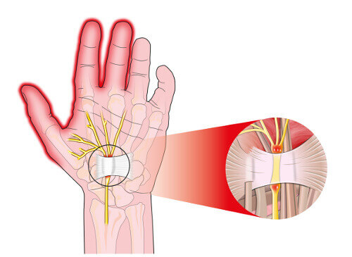 синдром на карпалния канал и болката в дланите