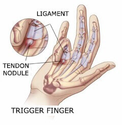Щракащият пръст е една от причините за болката в дланите и китките.