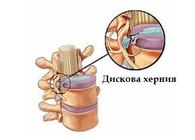 Симптомите на дискова херния (дископатия)