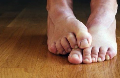 превенцията при онихомикоза е нйа-вече добрата хигиена