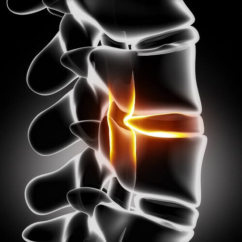 изместването на тъканта между костите в гръбначния стълб е причината за появата на дискова херния
