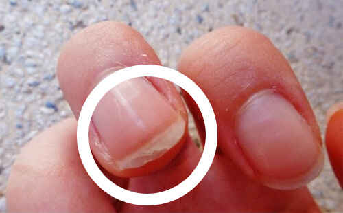 Защо се цепят ноктите? Причини, лечение и решения