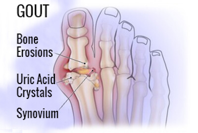 лечение на артрит - подаграта също спада към тази коварна болест