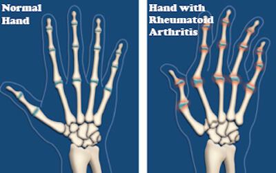 консултирайте се с лекар, преди да пристъпите към лечение на артрит