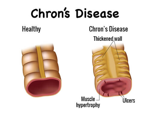 Болест на Крон: симптоми и лечение