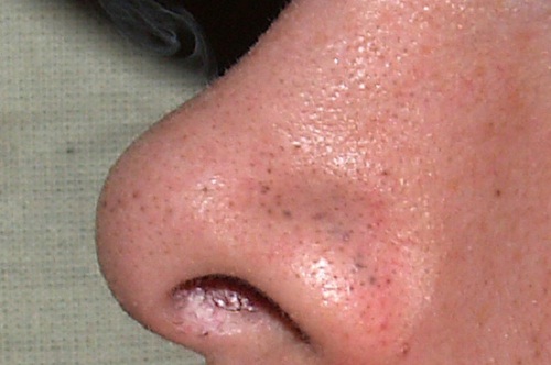 Ползи от лимона против черните точки