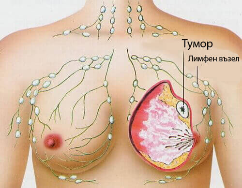 5 най-често срещани видове рак при жените