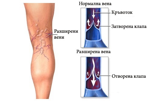 Студен душ предпазва от разширени вени