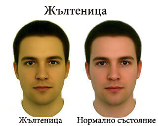 Кожни симптоми за жълтеница