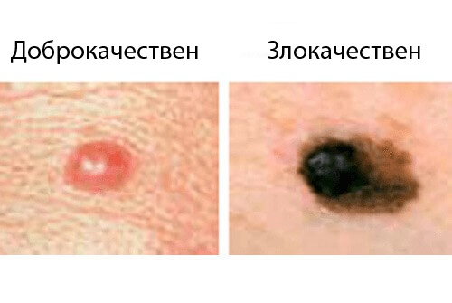 Злокачествен рак при жените