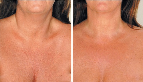 Домашни средства срещу бръчки по шията