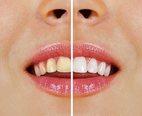 Начини за избелване на зъбите с натурални продукти