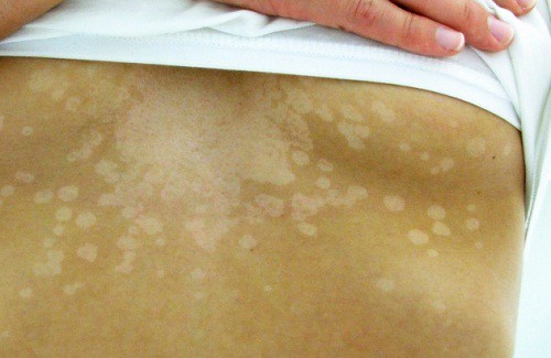 5 кожни симптома, че се разболяваме