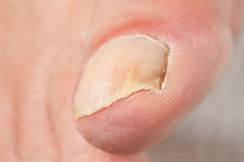 Промени на ноктите могат да бъдат признак за здравословни проблеми.