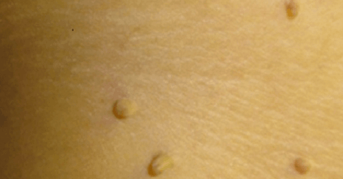 10 натурални средства за премахване на брадавиците