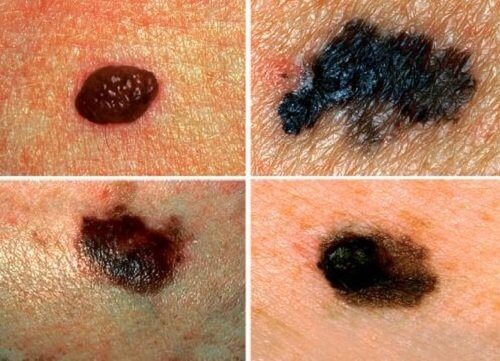 Предупредителни знаци за рак на кожата.