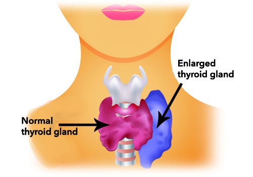 За регулиране на щитовидната жлеза при хипертиреоидизъм високоенергийни храни.