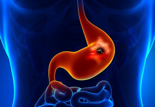 Причина за стомашни язви е инфекция, причинена от бактерията Helicobacter Pylori.