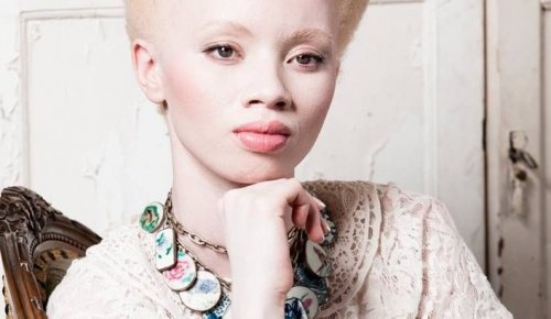 Явлението албинизъм често се свързва с рака на кожата. Жена албинос.