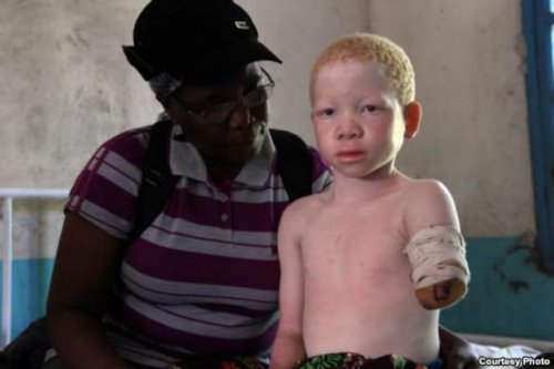 Албиниъм в Африка -истинско проклятие