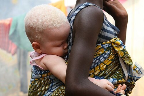 Дете албинос - какво знаете за албинизма