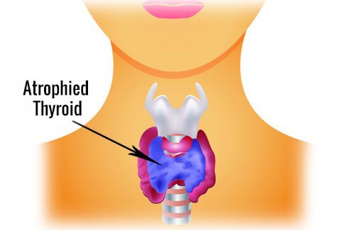 Намалете храната за регулиране на щитовидната жлеза при хипотиреоидизъм