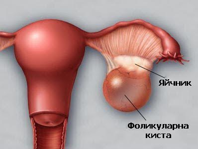 киста в яйчника също би могла да предизвика болка в лявата част на корема
