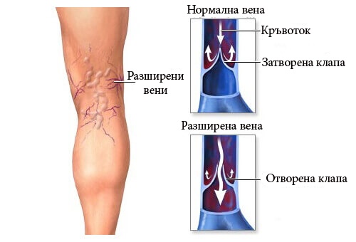 разширени вени