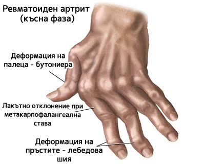 7 природни лека при артрит на ръцете