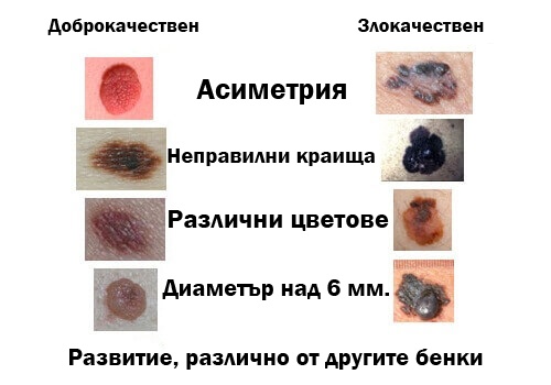 Признаци на рак на сожата.