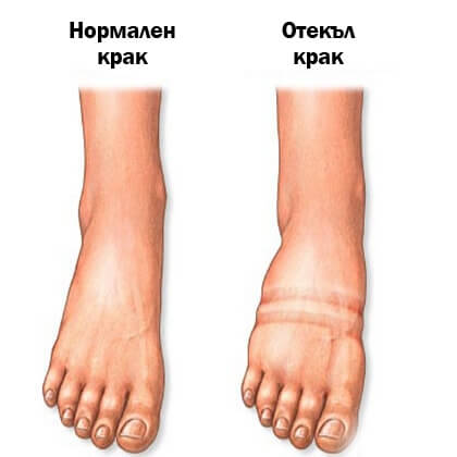 Задържането на течности е фактор за наличие на двойната брадичка