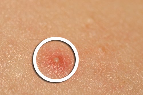 Пастата за зъби ефикасно се бори с акнето