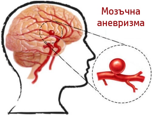 Аневризмата, как да я засечем навреме и да се предпазим от нея