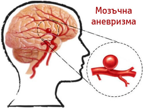 Аневризмата, как да я засечем навреме и да се предпазим от нея