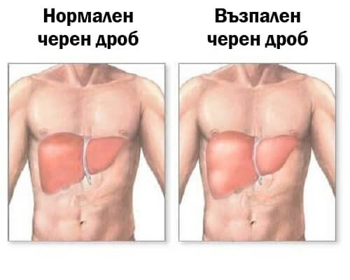 Възпалението на черния дроб: симптоми и диета