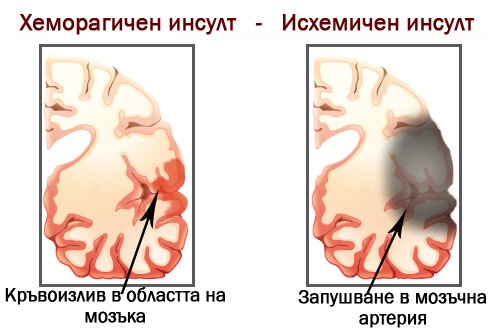 инсулти