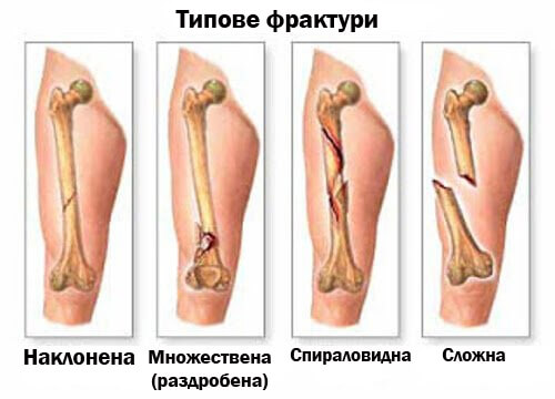 5 симптома на първичен рак на костите