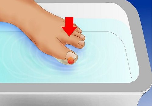 Как да лекуваме врастналите нокти на краката