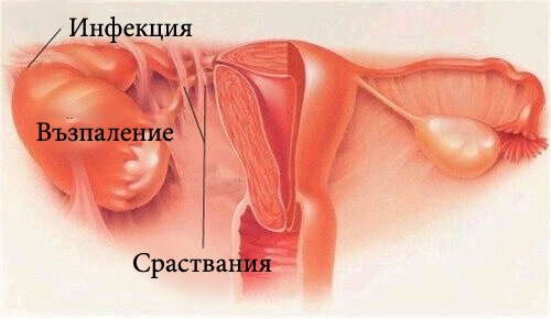 Симптоми на тазово-възпалителна болест (ТВБ)