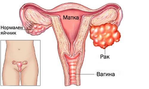 Генетични рискови фактори