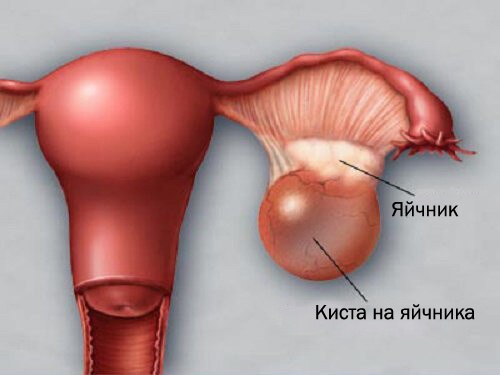 5 фактора, които влияят върху здравето на яйчниците