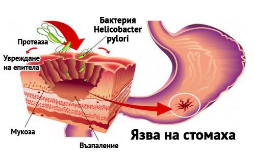 Как да се справим с бактерията Helicobacter pylori