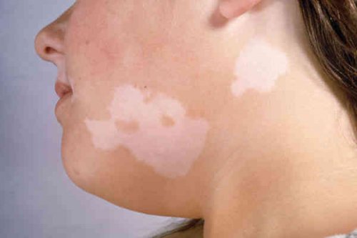 Витилигото е едно от заболяванията свързано с появата на бели петна по кожата.