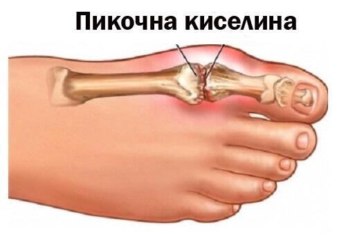 Повишените нива на пикочната киселина са основна прочина за подагра.