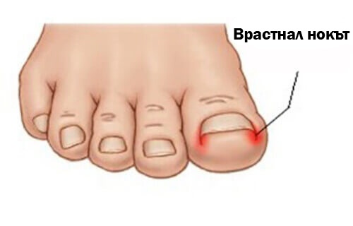Съвети за лекуване на врастналите нокти на краката