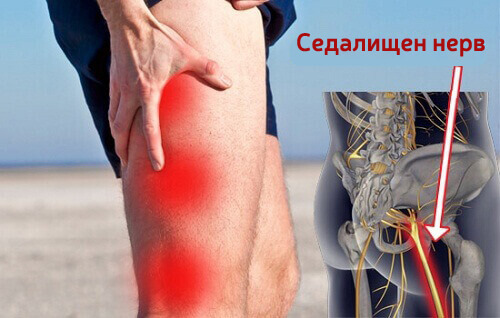 Натурални средства за лечение на ишиас