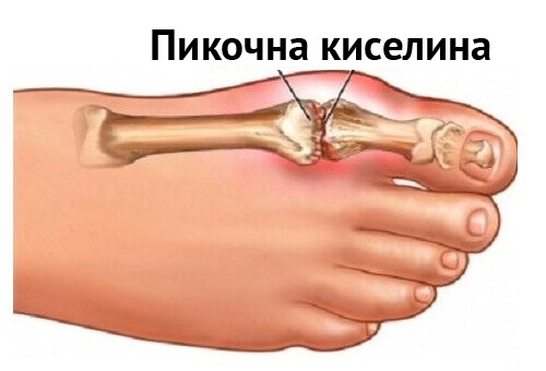 Приложение на артишок: намалява пикочната киселина